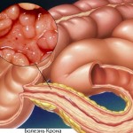 Создан новый препарат против болезни Крона
