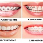 Классификация зубных брекетов по материалу изготовления